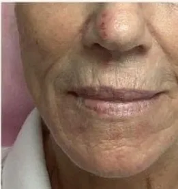 1 week after: BBL photofacial, redness and pigment at Vero Beach Medical Spa