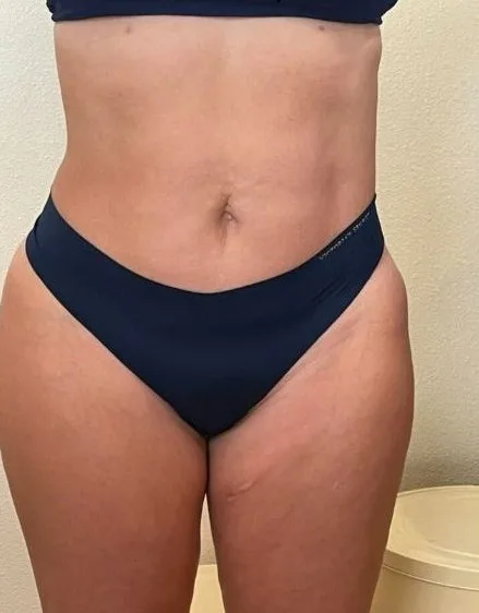 After: EmSculpt Neo, abdomen at Vero Beach Medical Spa