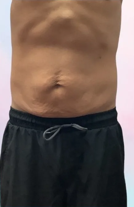 Before: EmSculpt Neo, abdomen at Vero Beach Medical Spa