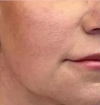 Before: AquaGold facial at Vero Beach Medical Spa