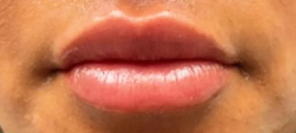 After: Lip filler at Vero Beach Medical Spa