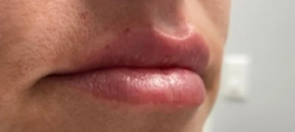 After: Lip filler at Vero Beach Medical Spa