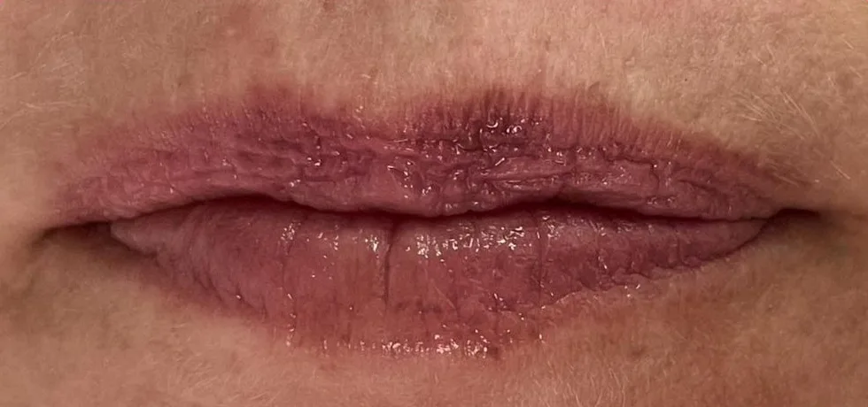 Before: Lip filler, lines and definition at Vero Beach Medical Spa