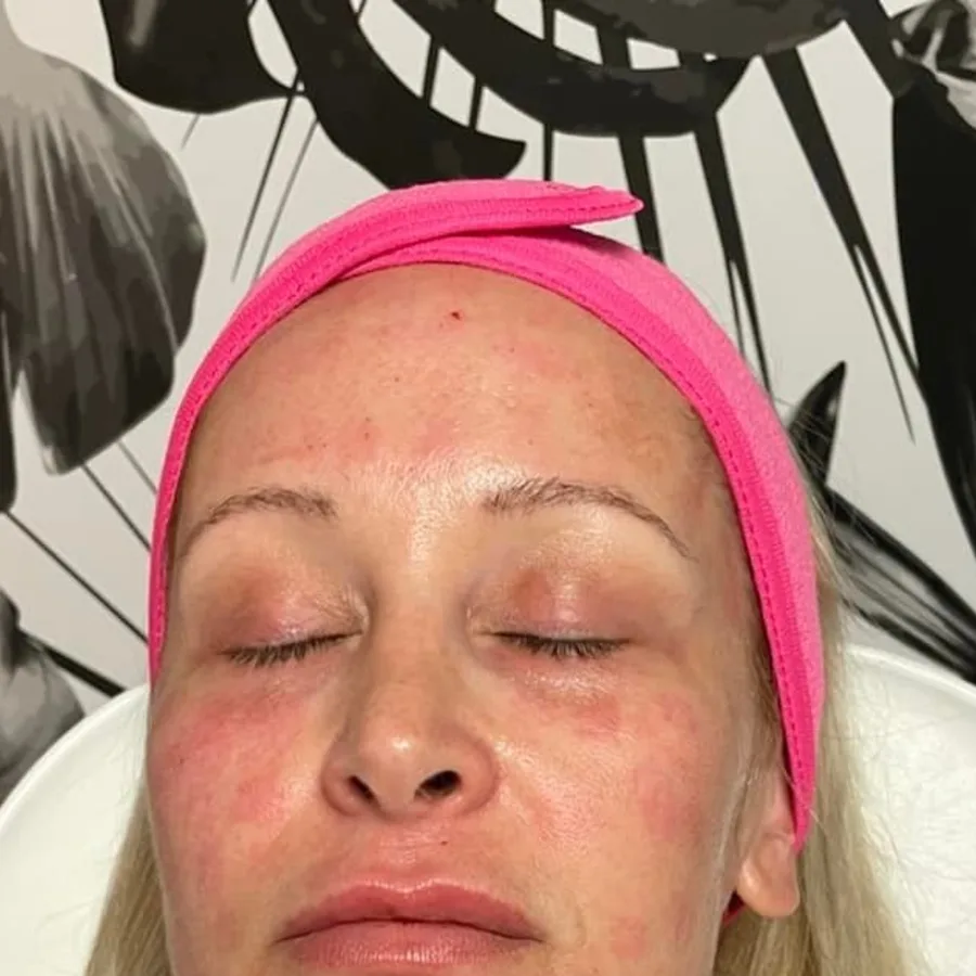 Right after: Dr. Million's own Morpheus8 face + neck treatment, downtime at Vero Beach Medical Spa